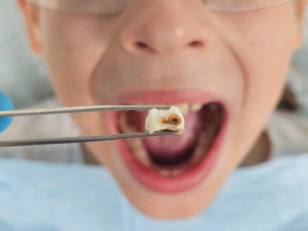 Emergency Dental Filling Replacement in OH