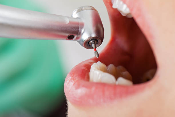 Best Emergency Dental Filling Replacement  in Glouster, OH